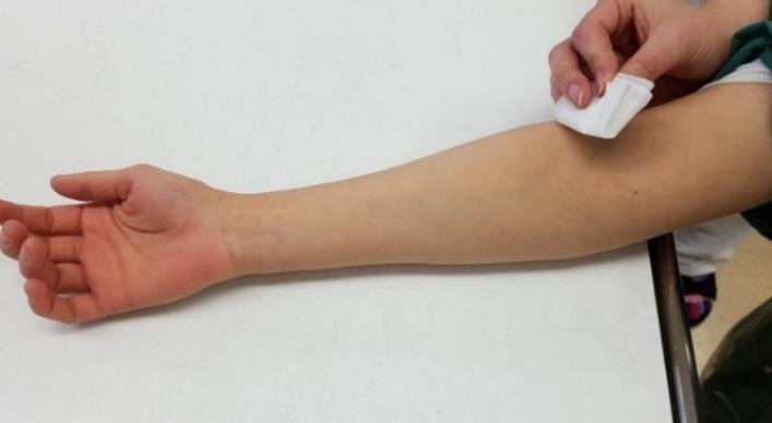 Desinfektera punktionsstället noga genom att gnida huden med tork eller kompress som är ordentligt genomblöt av klorhexidinsprit under minst 5