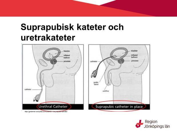 Hematurikateter används vid behandling av makroskopisk hematuri (synligt blod i urinen) På bilden kopplad till ett spoldropp som används för att skölja rent i blåsan och spola ut blodkoagler.