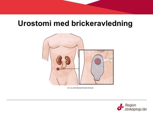 Urinledarna kopplas till en bit tunntarm som läggs som en stomi på magen. Detta kallas för brickeravledning.