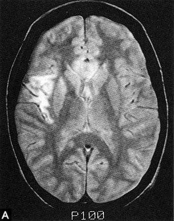 Antifosfolipidsyndrom (APS) Antiphospholipid antibodies and stroke Är en multisystemisk vaskulopati som kan leda till tromboemboliska händelser, graviditetskomplikationer