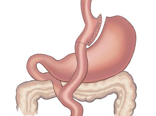 8c) Gastric-by-pass och graviditet Bariatric Surgery (Gastric-by-pass) Vänta ca ett år innan graviditet Folsyra 5 mg 1x1 (från 4 v innan planerad grav, hela grav) T.