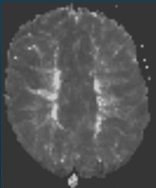 MRI Ett