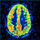 Grundprincip: Arterial spin labelling (ASL) Magnetiskt märkta vattenmolekyler ( ) reducerar magnetiseringsvektorn M M Detta leder till lägre signal i bilden större sänkning i regioner med hög