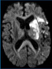Patient med cerebral