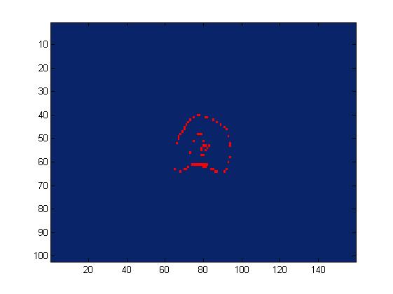 (a) Reference plan (b) The MLC bank shifted -1.0 mm (c) The volume difference between reference plan and the MLC bank shifted -1.0 mm. Figure 25.