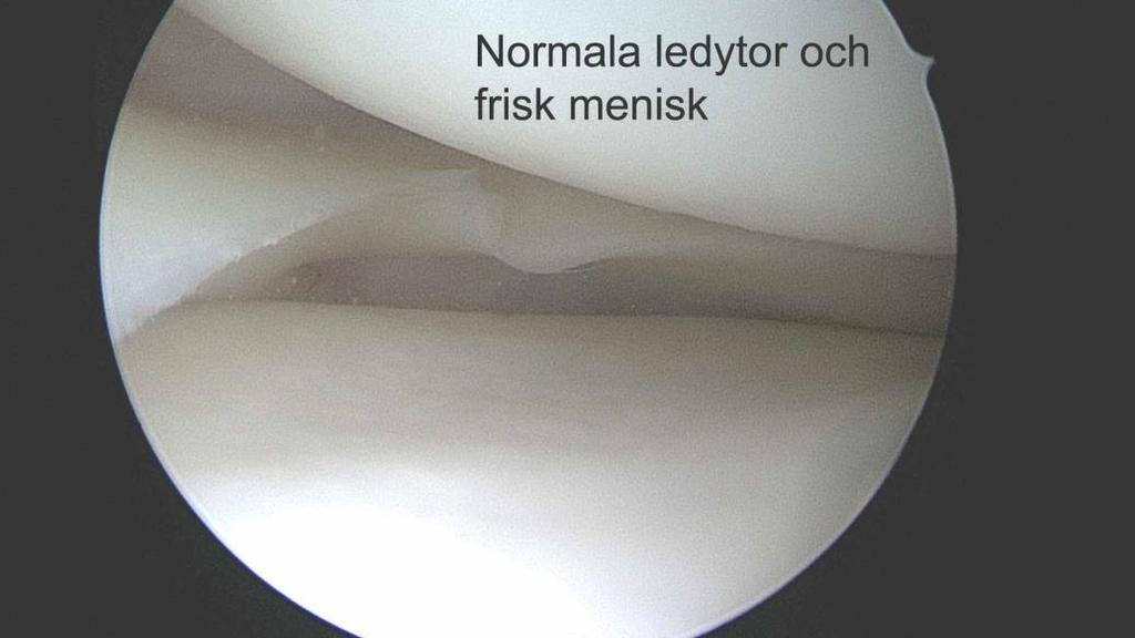 diskoida menisken som istället för halvmåneform är rund som en skiva (disk).