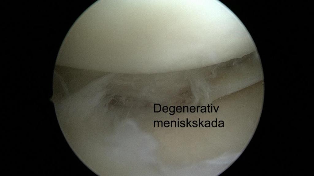 Ett vanligt fynd i medelåldern är en sk. "degenerativ" eller åldersrelaterad meniskskada.
