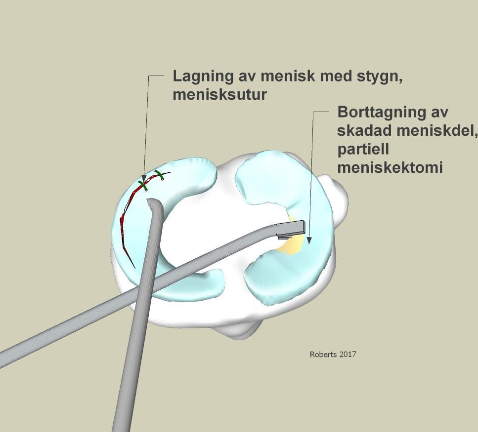 C. Som nämnts ovan behandlas de degenerativa skadorna generellt icke kirurgiskt med sjukgymnastik och antiinflammatorisk medicin vilket kan innefatta både tabletter och kortisonspruta.