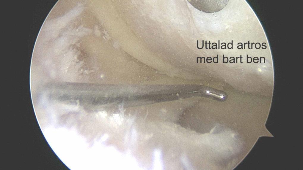 Det är dock en känd klinisk observation att en knästukning i medelåldern kan "sätta igång" en smärtproblematik från ett knä med