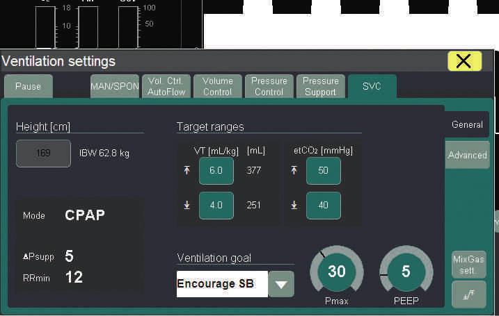 04 Enkel En intuitiv syn på ventilation både: D-2367-2016 Användargränssnitt för Smart Ventilation Control (SVC) på Zeus Infinity Empowered Inbyggd klinisk