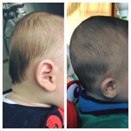 Mimos + fysioterapi: En liten pojke som vid 5 mån startade behandlingen hos
