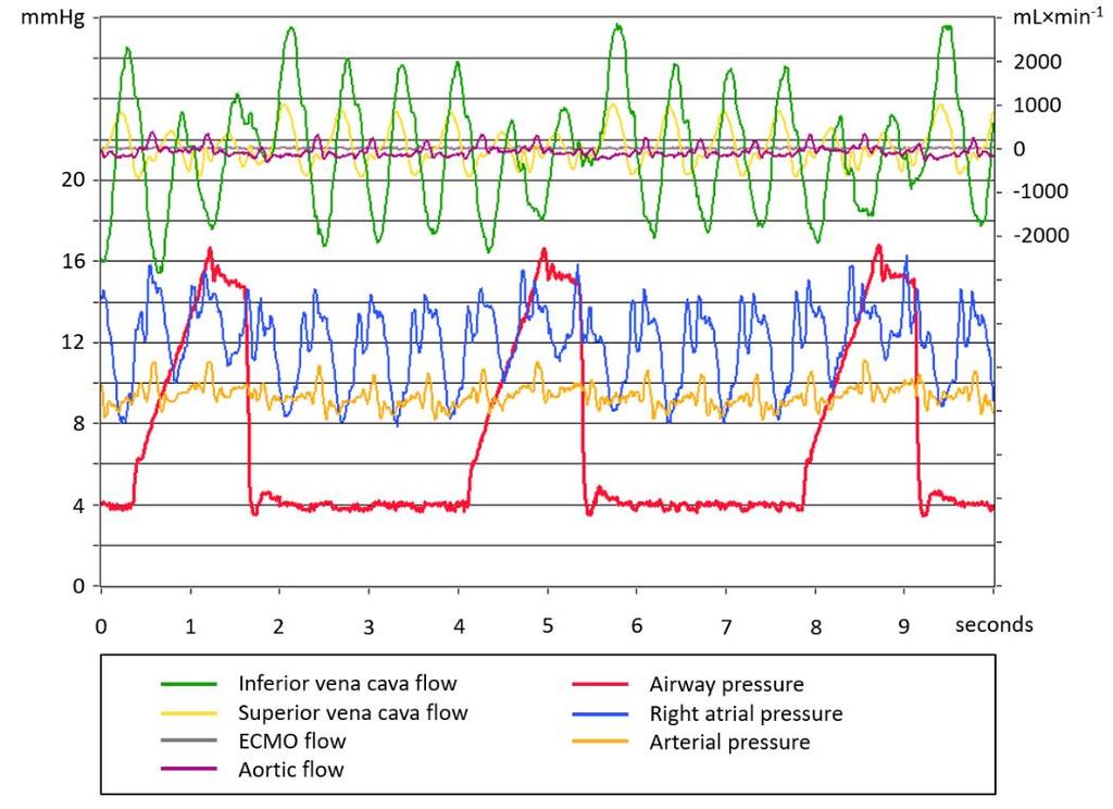 Per Werner Möller immediately after death (46, 86). In the present study, MSFP was higher in inspiration than in expiration, regardless of shunt state but only in Euvolemia.