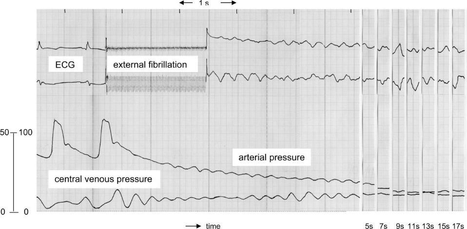 Per Werner Möller Figure 9 - An example of a Fibrillation-Defibrillation Sequence (FDS) from Schipke (90).