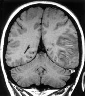 inväxt i sinus sagittalis superior Neuro-MRA
