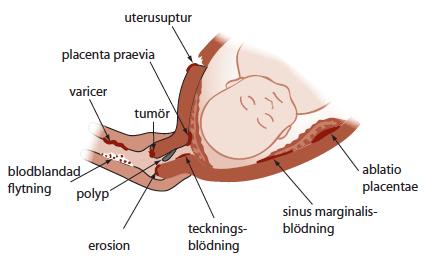 Klinisk diagnos Ultraljud tillför ingenting för diagnosen ablatio - men för att se