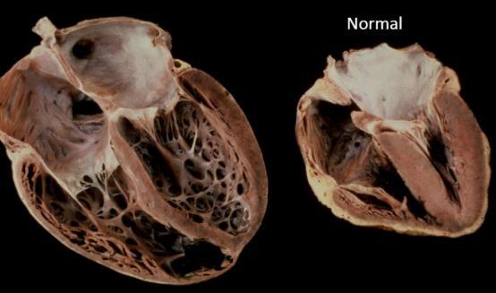 Diagnos Klinisk hjärtsvikt i slutet av 3:e trimestern 5 mån post partum Ingen tidigare hjärtsjukdom