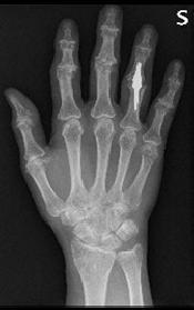 Kontinuerlig inflammation, värk, svullnad och rörelsebegränsning i mellanleden av något finger kan också behandlas med mellanledsprotesoperation
