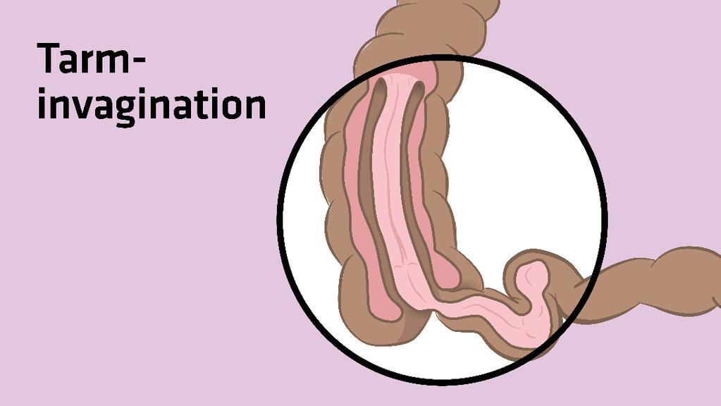 Tarminvagination som sjukdom utan koppling till vaccination Högst incidens vid 3 9 månaders ålder Incidens i Sverige: 0.