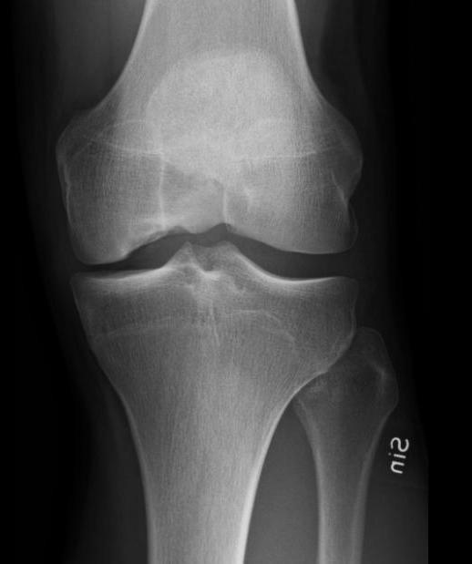 Patientinformation Osteokondrit (osteochondritis dissecans OCD) GHP Ortho Center