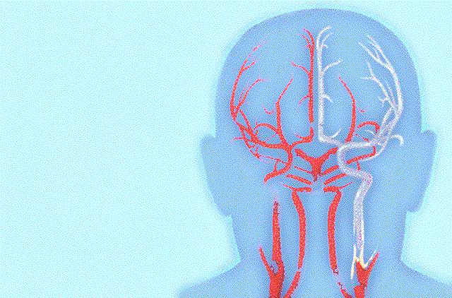 blödning 5% 54 Internmedicin, 2006 55 Waranbehandling mot placebo efter stroke/tia EAFT