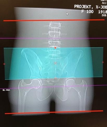 Figure 3.8: Scan lengths used for the CT protocols. The blue box represents the scan length for the late series EVAR and the red lines represents the scan range for all the other CT protocols. 3.4 Fusion To measure the radiation dose when performing 2D fluoroscopy, for 2D-3D-fusion in EVAR procedures, the abdominal phantom was used on Artis Q.