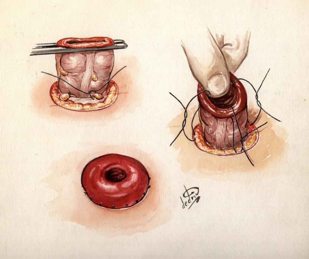 1.2 SURGICAL TECHNIQUE OF STOMA CONSTRUCTION Adiela Correa Marinez Figure 1.