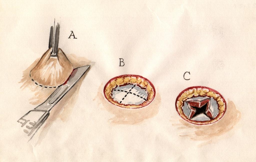 Aspects on colostomy construction, complications and stoma function Which size and height the stoma should have, what form, and how to perform the opening in the abdominal wall, and whether there is