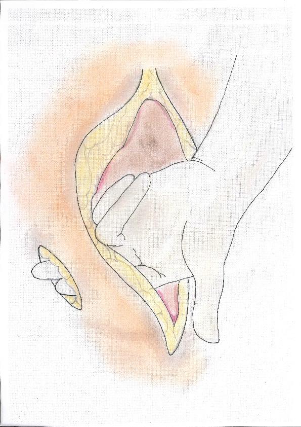 Adiela Correa Marinez The size of the trephine opening According to most textbooks and also in accordance with our own clinical experience, the standard measure used is two fingers width or just