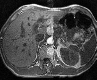kontrastmedel vid MR-scanning av levern för patienter med nedsatt njurfunktion 280 000 patienter med nedsatt njurfunktion på större marknader Adresserbar marknad på 350-500 MUSD Målgruppen för