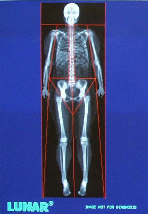 Muscle mass by DXA Appendicular lean soft tissue (ALST) = Lean soft tissue (LST) in arms + legs Skeletal muscle mass (SM, kg): 1.19 x ALST 1.