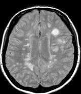 sjukdomsförloppet Miljöfaktorer Diagnostik Symtom från minst två olika anatomiska lokalisationer i CNS Symtom
