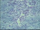 Axon förlust Progressiv MS Organspecifik autoimmun sjukdom SJUKDOMSFÖRLOPP Immunomodulerande behandling kan övervägas vid hållpunkter för inflammatorisk sjukdomsaktivitet: skov och/ kontrastladdande