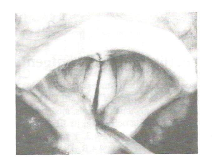 Figur 4. Bild av glottis, luftspringan mellan stämbanden tagen uppifrån. Det vita fallskärmsliknande är epiglottis, struplocket som kan höjas och sänkas (Lindblad, 19