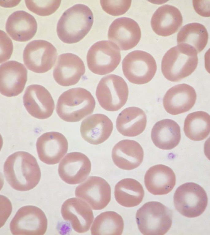 Överhydrerad Stomatocytos (Hydrocytos) OHS Permeabilitetsrubbning i erytrocytens cellmembran Mycket ovanlig 20 fall beskrivna 2016 Mutation i RhAG Svårare fenotyp än DHS MCHC 240-300 g/l MCV >110