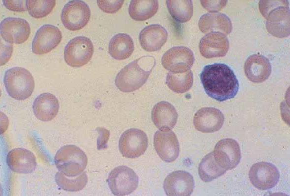 basket cell Hemoglobinuri Måttl