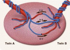 TTTS 10-15% av monokoriota tvillinggraviditeter Orsak: Gemensam placenta med anastomoser i mellan. Stadieindelning (Quintero) 1. Poly/oligo (>8cm/<2cm SDP) 2.