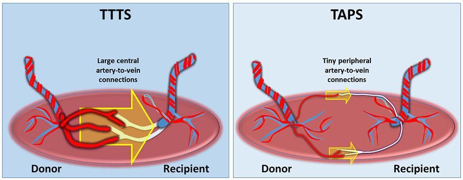 TAPS (twin anemia polycythemia sequence) -Kan förekomma efter