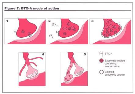 Background: Retrospective survey of predictive factors for spasticity reducing injections with BoNT in the upper limbs in children with CP.