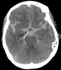 Subarachnoidalblödning (SAH) Blödning som oftast (60%) uppstår ur ett pulsåderbråck (aneurysm) Kan också orskas