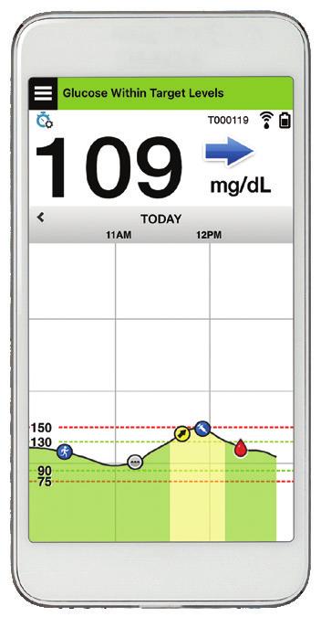 Eversense XL CGM-Systemkomponenter Systemet omfatter: 1) en liten sensor satt inn subkutant av helsepersonell, 2) en avtagbar Smart-sender som bæres over sensoren, og 3) en mobilapp som viser