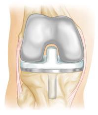 Too often, health-care providers passively await final joint death, necessitating knee and hip replacements.