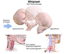 Whiplashvåld: DEFINITIONER Påfrestning av halsryggens och huvudets strukturer