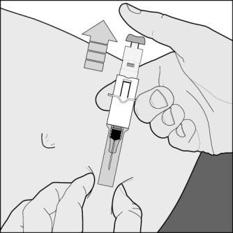 Bild F Spruta med manuellt system 9. Efter injektionen, håll sprutan i ena handen genom att greppa runt skyddshöljet, använd den andra handen för att hålla fingergreppet och dra det bestämt bakåt.