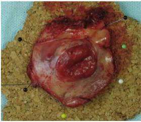 Sentinel lymph node Sentinel lymph node (SLN) bör inte skickas för fryssnitt utom vid undantagsfall tex när man misstänker metastasering i SLN.
