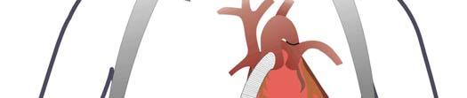 Alla serienummer av Thoratec HeartMate II implantatkit med förslutna graft (katalognr.