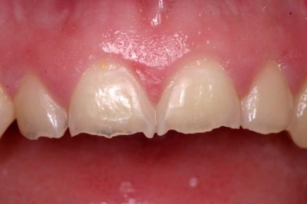 Orsaksfaktorer till dental erosion brukar delas in i yttre och inre faktorer Yttre faktorer (via munnen) Syrapåverkan