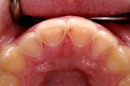 faktorer (ett surt maginnehåll når munhålan och tänderna) Kräkningar (ätstörningssjukdom där kräkningar ökar risken för