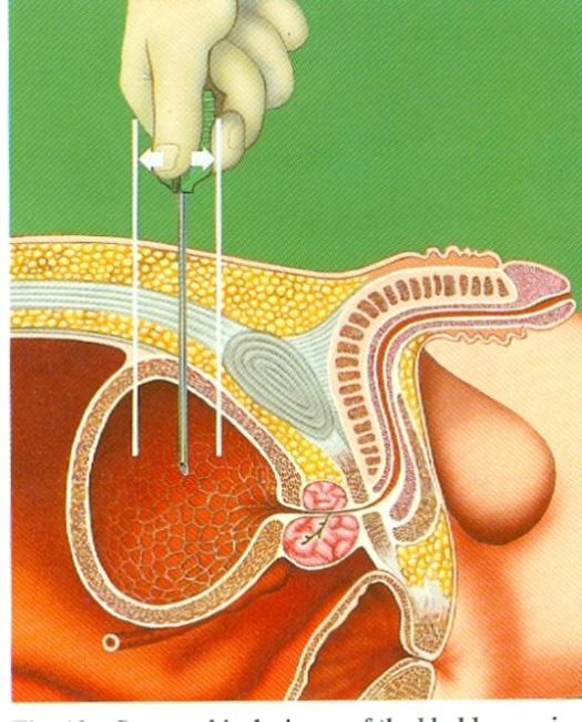 Teknik vid suprapubisk kateterisering Ingreppet ordineras och utförs av läkare under sterila förhållanden.