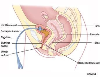 Suprapubisk kateter Indikation för suprapubisk kateter (via bukväggen) Minskar besvär från urinröret och bör alltid övervägas som förstahandsalternativ till KAD vid permanent avlastning av urinblåsan