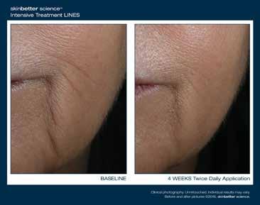 InterFuse Intensive Treatment LINES A no-needle hyaluronic acid solution that improves the